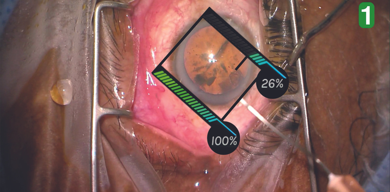 Clear Corneal Incisions