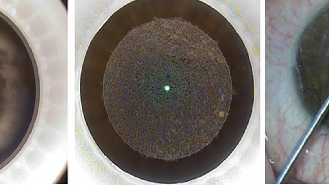 Refractive Surgery Mayday