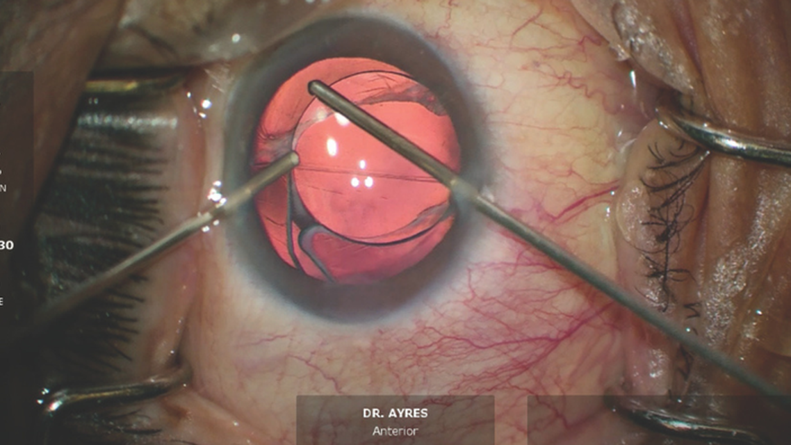 Postoperative Anisometropia