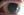 Figure 2. Corneal edema and large, dense keratic precipitates.