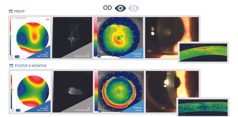Customized Treatments for Patients With Poor Visual Acuity