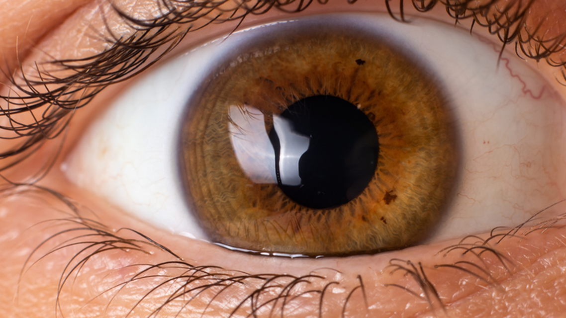 Small Aperture IOLs in Eyes With Irregular Corneas