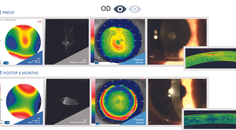 Customized Treatments for Patients With Poor Visual Acuity