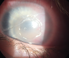 A Complex Case of Treatment Resistant Pediatric Neurotrophic Keratitis