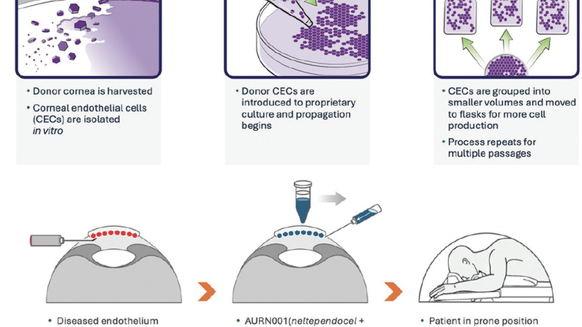 Corneal Endothelial Cell Therapy