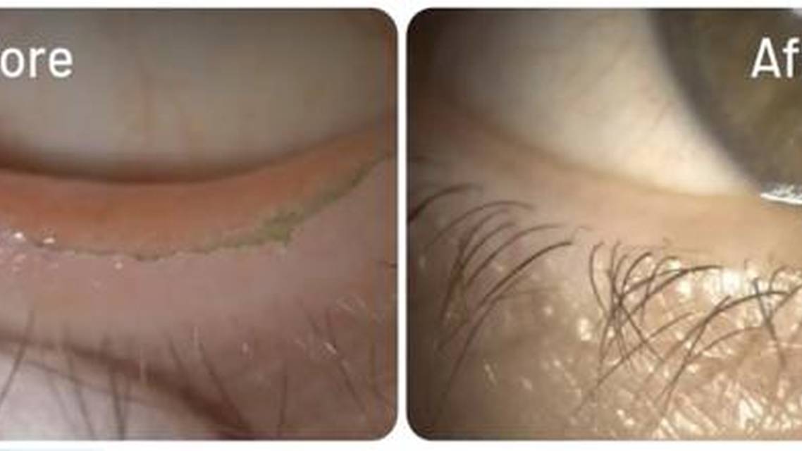 Effectively Treating Demodex Blepharitis