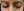 Figure 3. Grayish-blue hyperpigmentation of the periocular skin of the left eye.