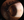 Figure 1. Keratoconus in a young patient requiring CXL.