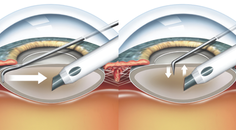 A History of Phaco Chop