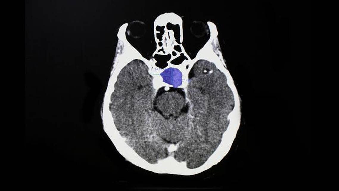 Ophthalmic Presentations of Pituitary Adenoma