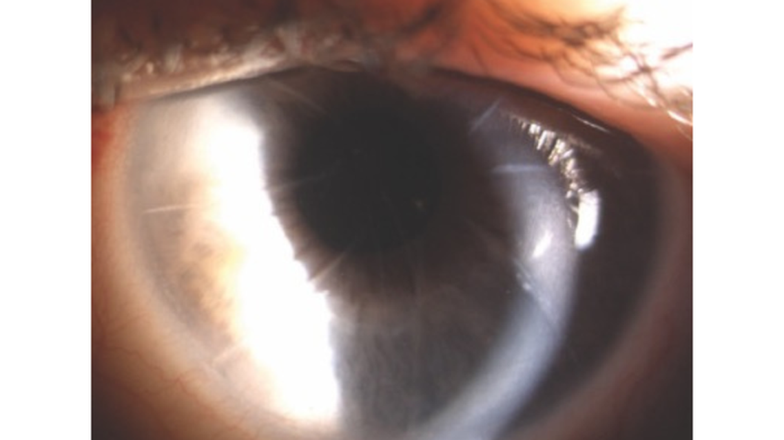 Refractive Treatment Options After Radial Keratotomy