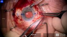 GoreTex Sutured Envista Envy thumbnail
