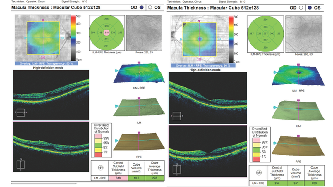 Epithelial Basement Membrane Dystrophy and Ocular Surface Disease