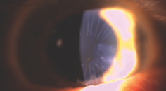 A Patient With Dry AMD Desires Improved Vision