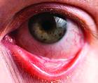 Approaches to Dry Eye Disease