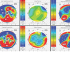 Multifocal Corneas