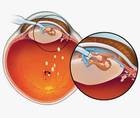 Improving Fluid Dynamics in Laser Cataract Surgery
