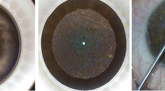 Refractive Surgery Mayday