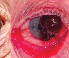 Conjunctival Melanoma