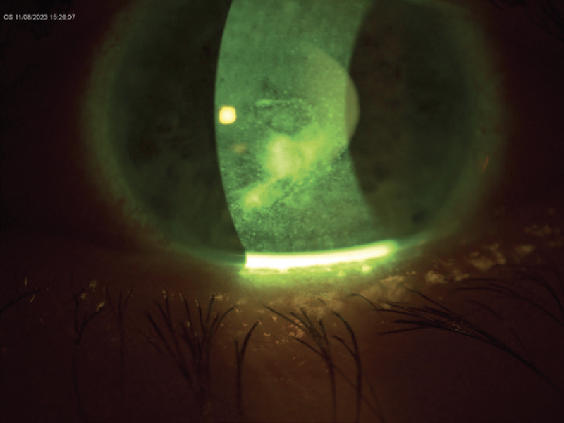 Neurotrophic Keratitis Post Retinal Detachment Surgery