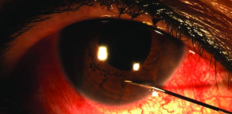 Leaky Anterior Chamber Paracentesis