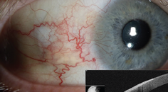 Ocular Surface Squamous Neoplasia in an Avid Sailor With Poor Compliance to Sun Protective Measures