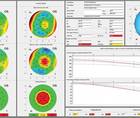 Keratoconus Pediatric Prevalence and a New Treatment Option