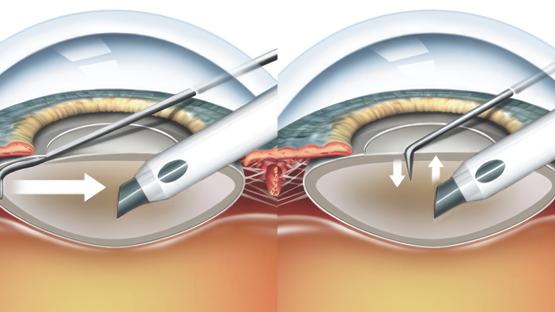 A History of Phaco Chop