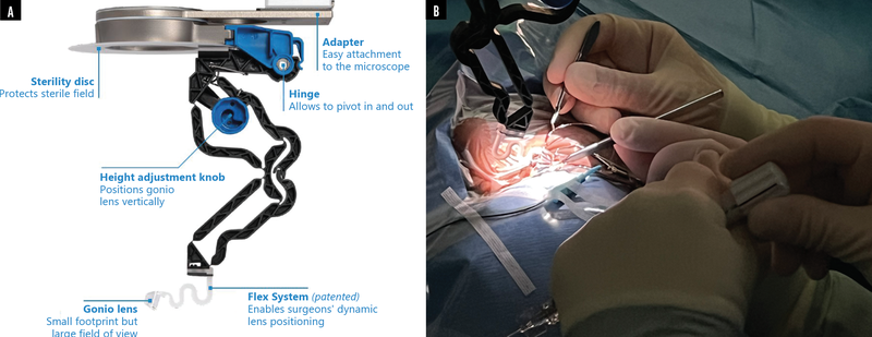 GONIO ready A New Gonioscopy System That Could Improve Your Surgical Approach With MIGS