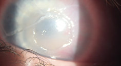 A Complex Case of Treatment Resistant Pediatric Neurotrophic Keratitis