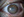 Figure 2. Immediately after treatment with cenegermin, the patient’s BCVA was hand motions, but the corneal epithelium was intact.