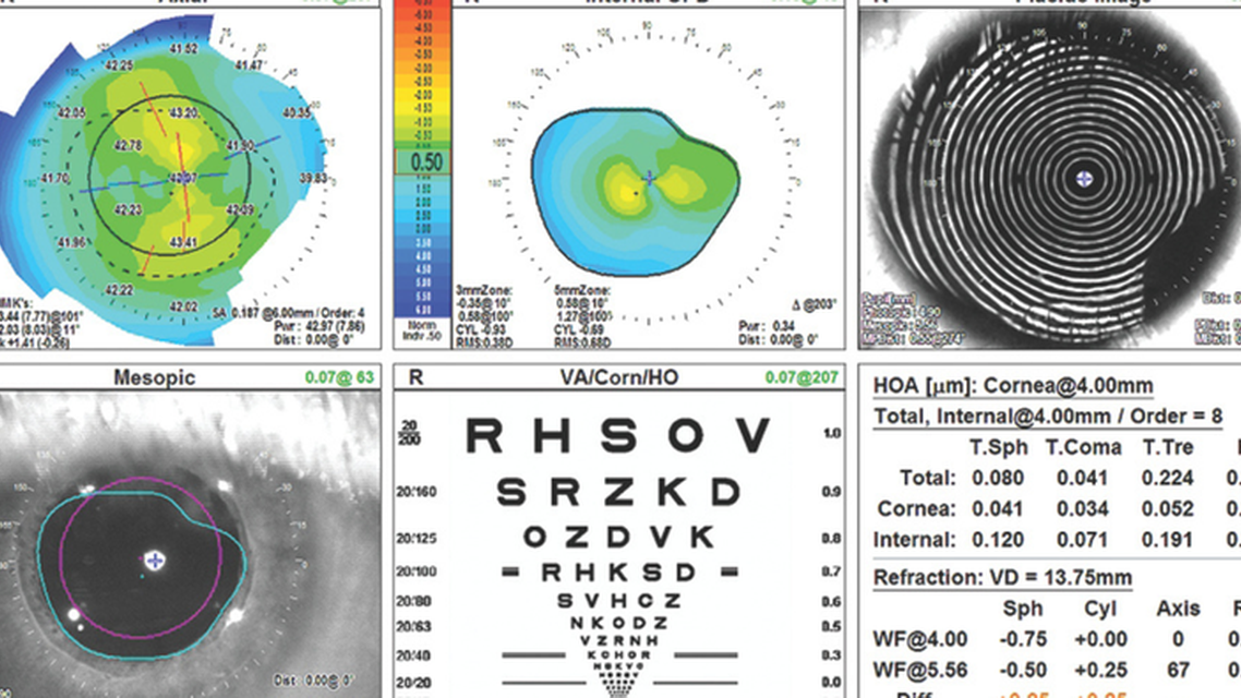 Cataract Management in a Young Adult With a Seizure Disorder