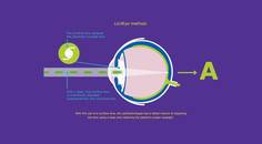 Making Room for Future IOL Technologies