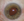 Figure 2. Pupillary capture despite two laser peripheral iridotomies in the office. The arrow designates the haptic to be repositioned more posteriorly.