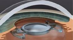 Precisight Multicomponent IOL