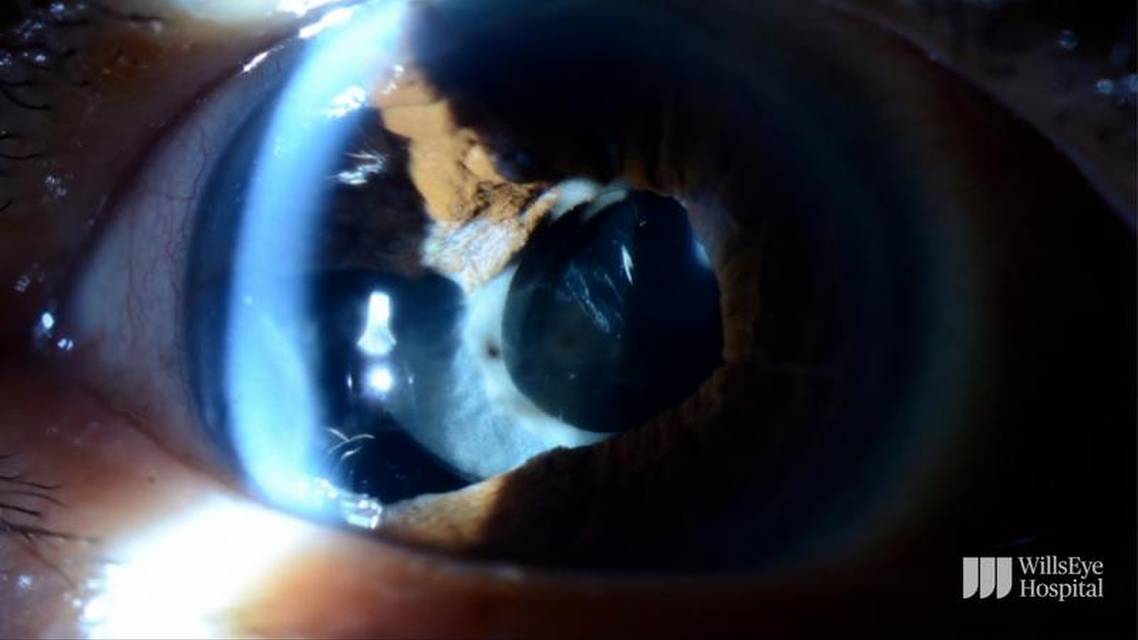 Iris Repair Following Complicated Cataract Surgery thumbnail