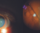 Traumatic Cataract Secondary to Needle Puncture for Intravitreal Injection
