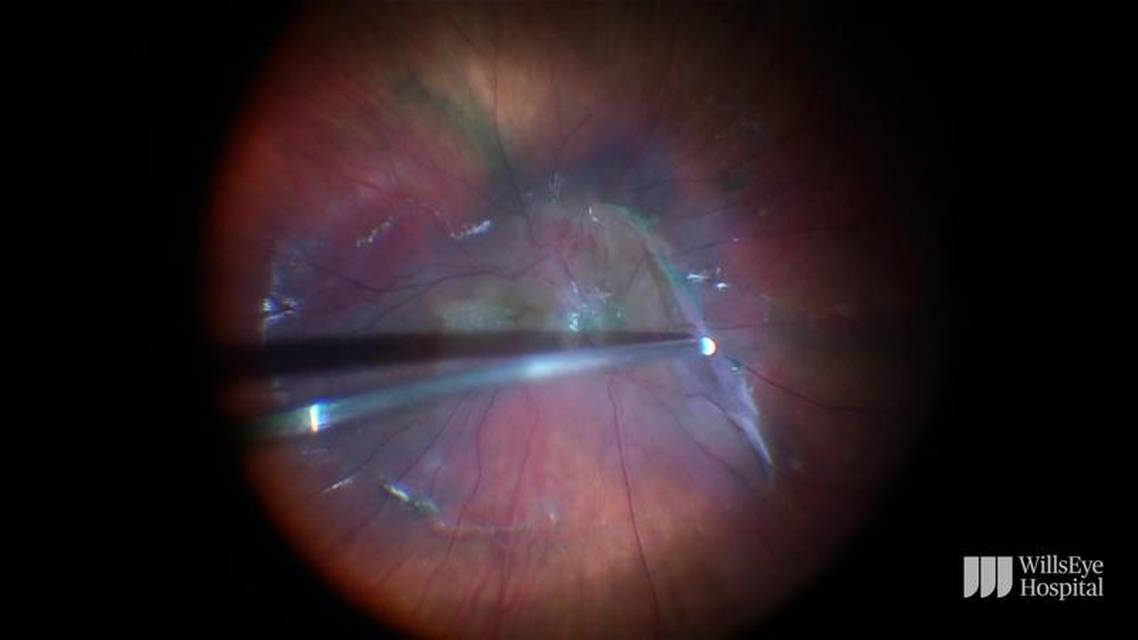 Complex Membrane Peel in Case of Combined Hamartoma thumbnail