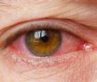 Aggressive Recurrent Inflammation After LASIK