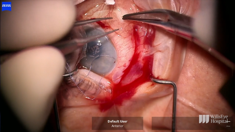 Hypotony Challenge Choroidal Effusion Drainage and Compression Suture thumbnail