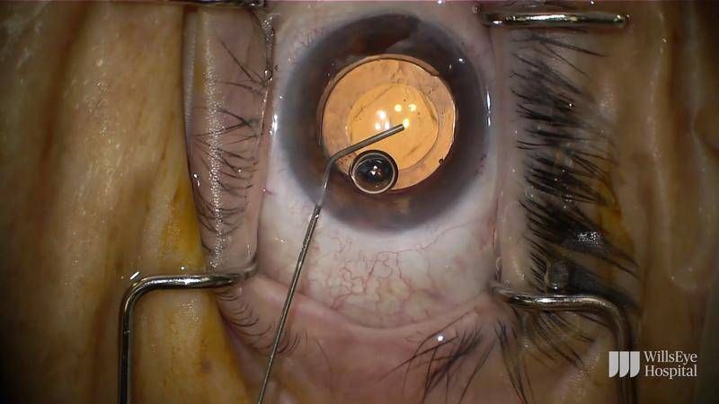 IOL Exchange Following Cataract Surgery thumbnail