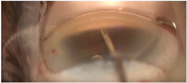 Hand in Hand MIGS and Advanced Refractive Cataract Surgery