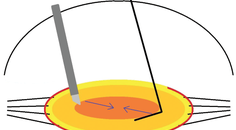 Zonulopathy and the Dense Cataract
