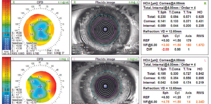 Cataracts and Russian Style Radial Keratotomy