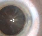 Dense Brunescent Unilateral Cataract