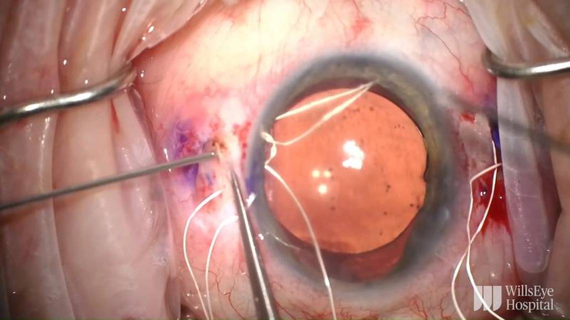 Management of Extensive Cyclodialysis Clefts thumbnail