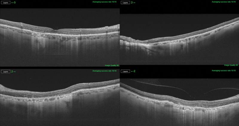 New Software Study GA AMD Quantification