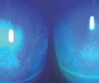 Testing Corneal Sensation Is Important