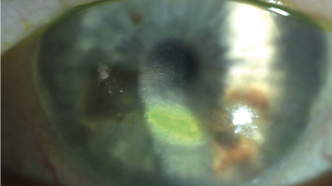 Expanding Options for Persistent Corneal Ulcer