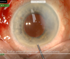 Suprachoroidal Hemorrhage